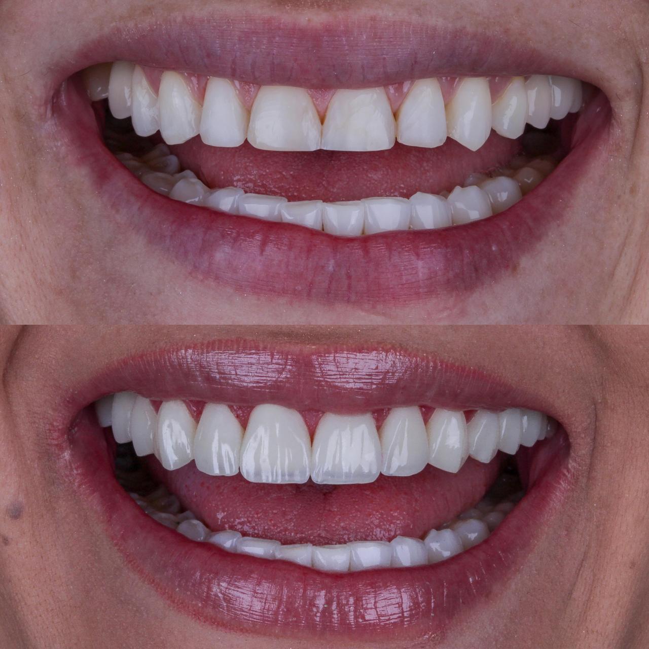 Antes e depois de tratamento estético do sorriso
