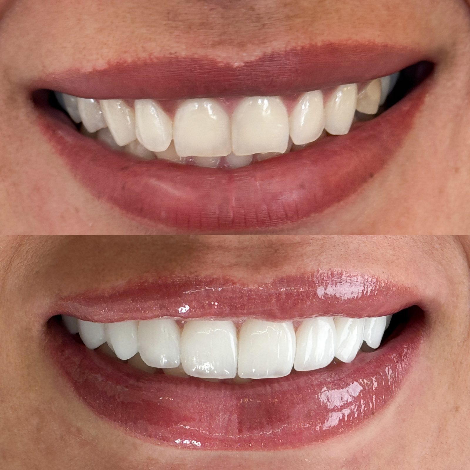 Antes e depois de tratamento estético do sorriso, caso 3