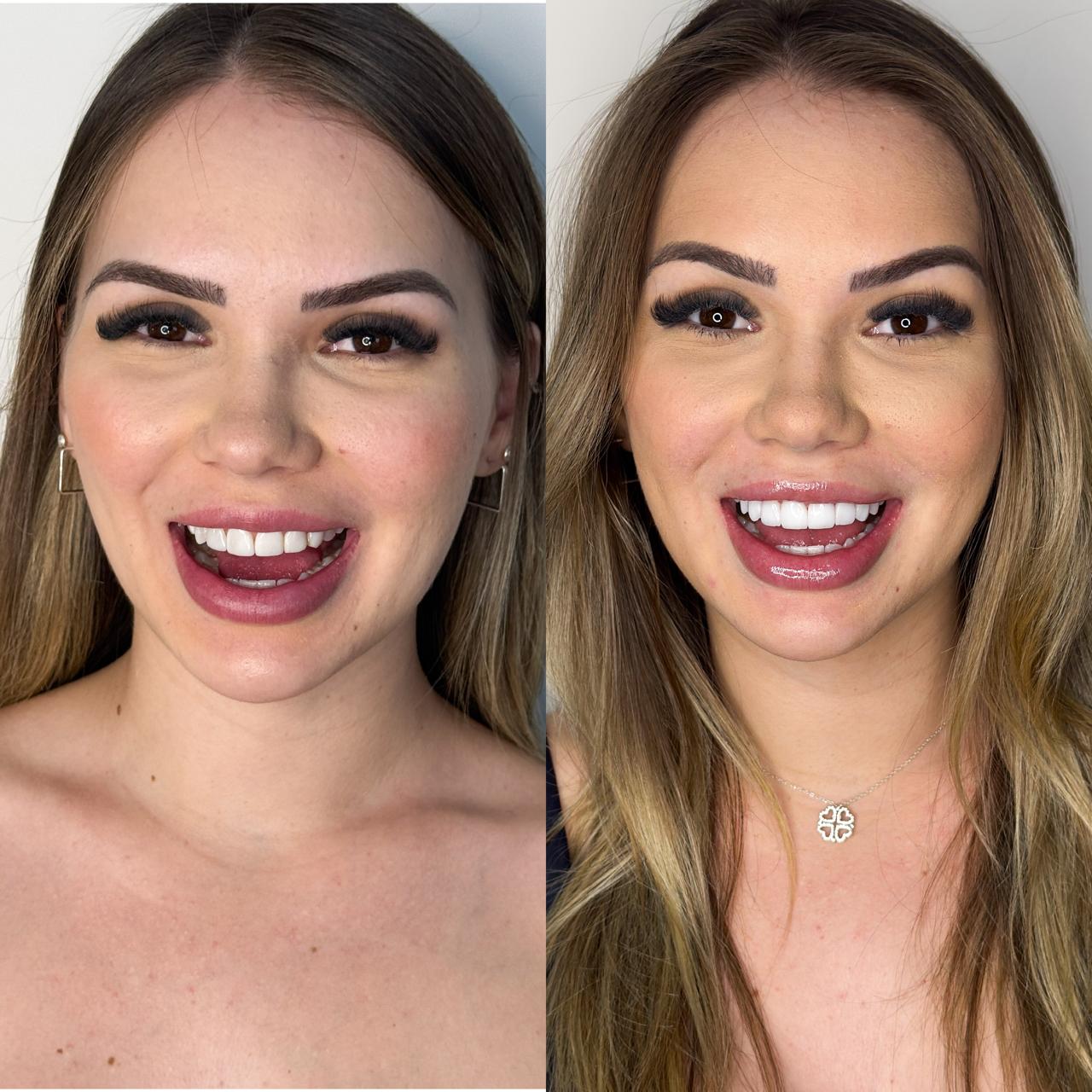 Antes e depois de lentes de resina
