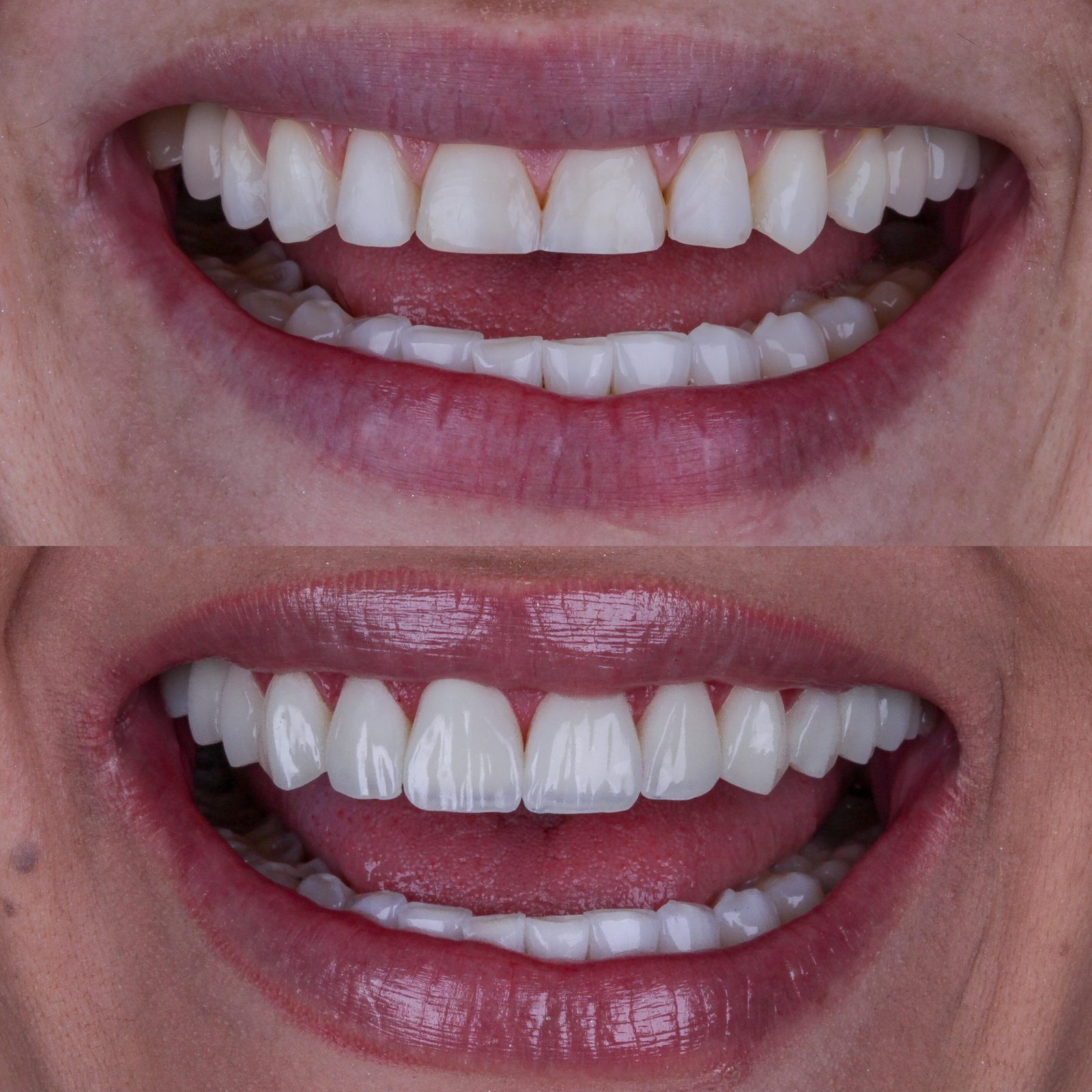 Antes e depois de tratamento estético do sorriso, caso 4