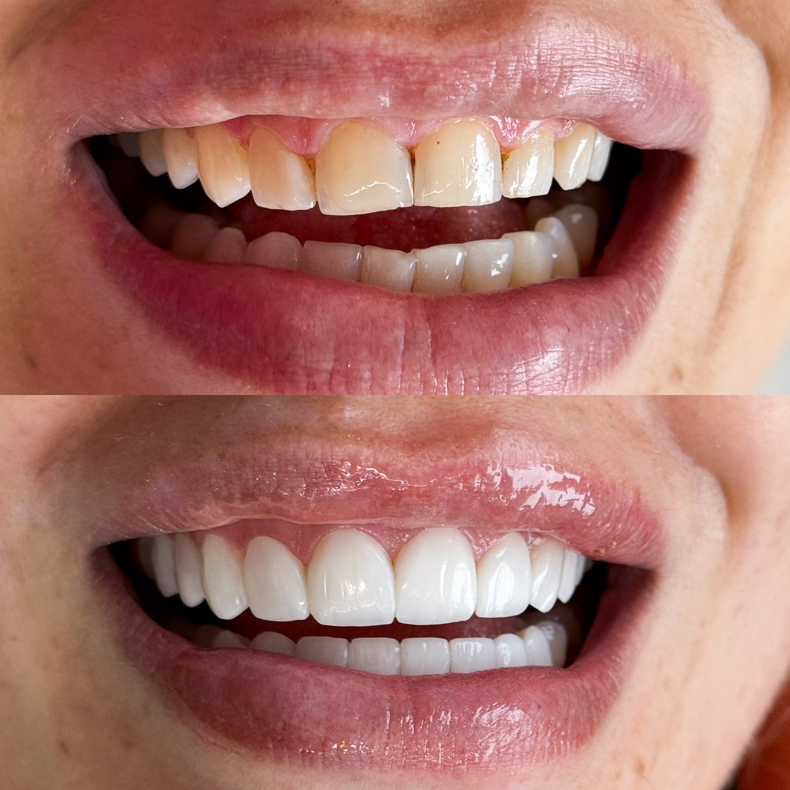 Antes e depois de tratamento estético do sorriso, caso 2
