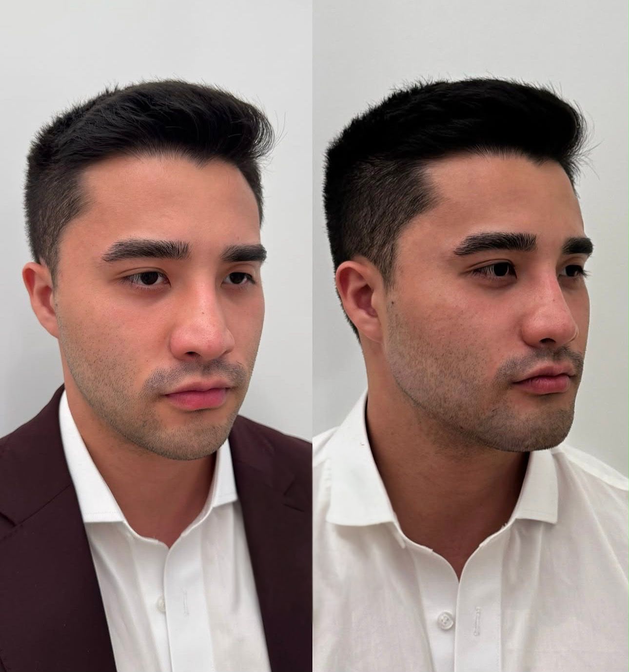 Antes e depois de harmonização orofacial