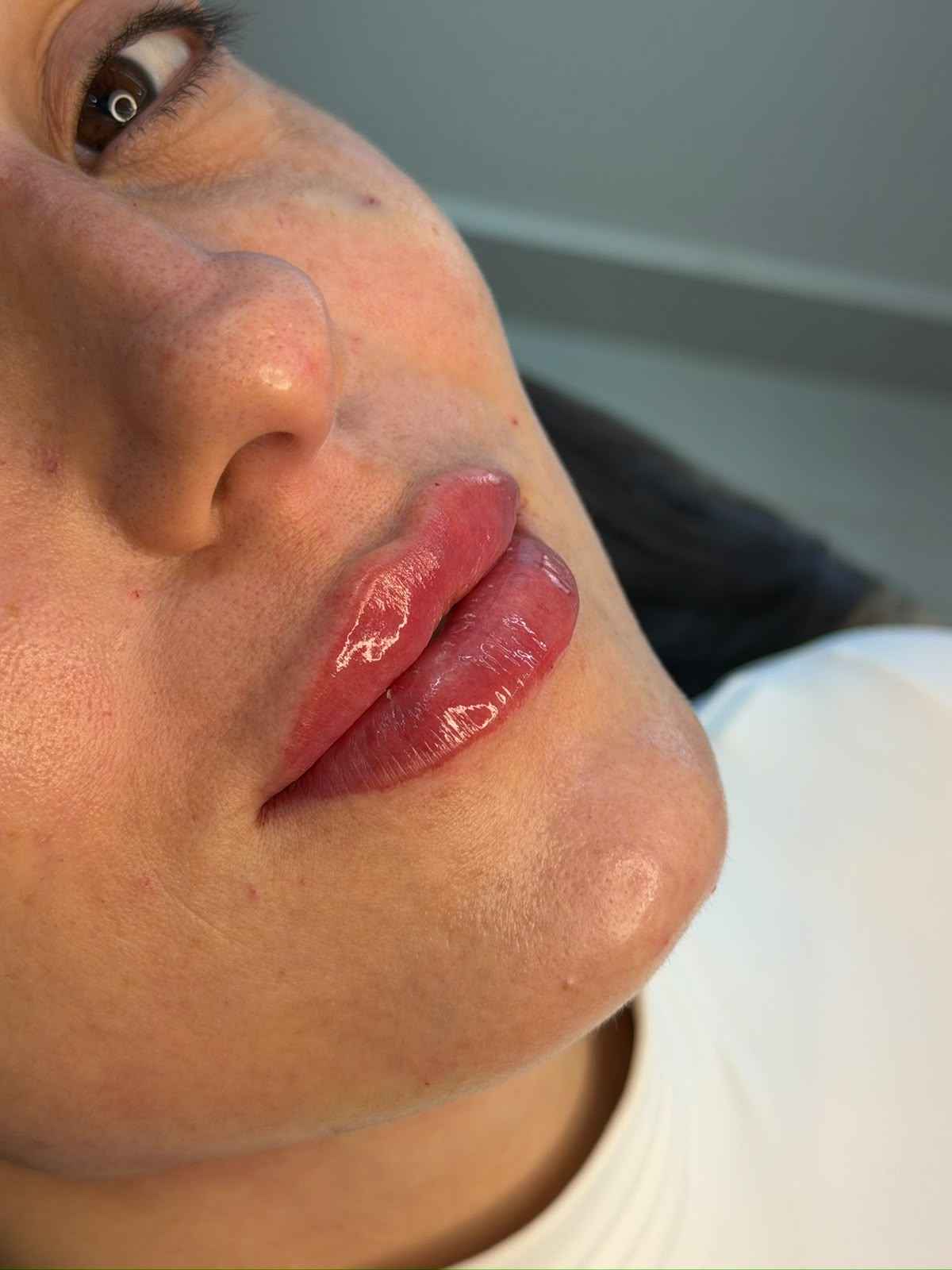 Resultado de preenchimento labial
